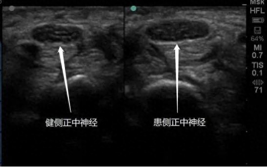 鼠标手纳入职业病，完善公共政策惠及更多劳动者